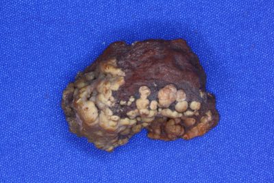 Mimetitt A krystaller på moderstein fra San Luis Potusi i Mexico 14g 2x3cm